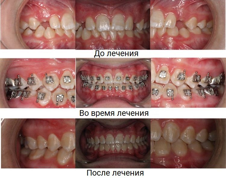 До лечения, во время лечения и после лечения До лечения, во время лечения и после лечения брекет-системами