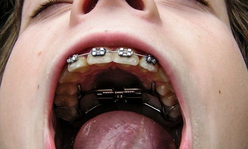 Брекеты во рту Брекеты во рту